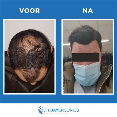 Haartransplantatie Voor En Na: Impact Op Het Zelfvertrouwen