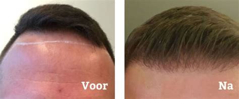 De Meest Gestelde Vragen Over Haartransplantatie