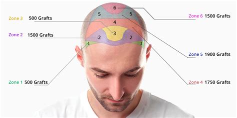 Haartransplantatie Kosten: Een Gedetailleerde Uiteenzetting