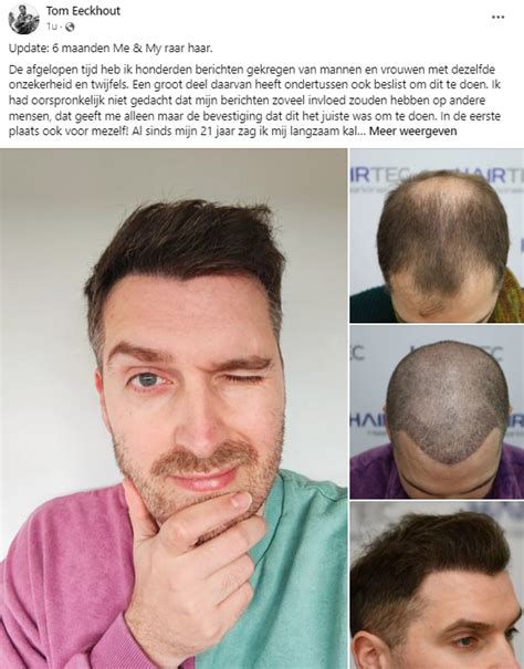 Lifestyle Tips Voor Het Behopen Van Een Succesvolle Haartransplantatie