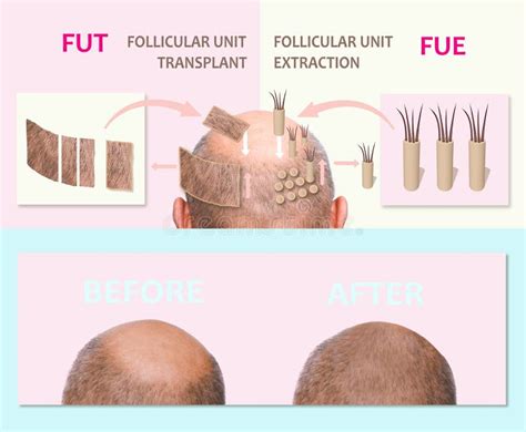 Verschillende Methoden Van Haartransplantatie: DHI Vs. FUE