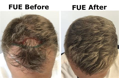 Haartransplantatie Technieken: FUE vs. FUT