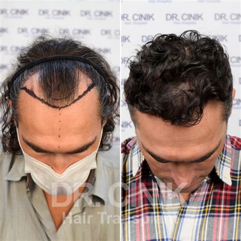 Haartransplantatie Trends Voor 2023