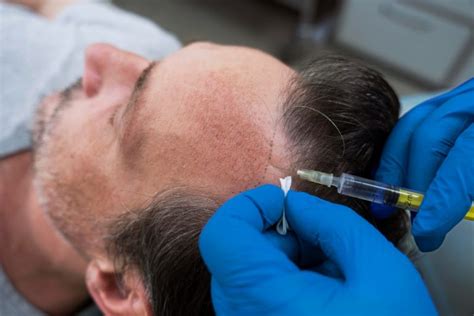 Hoe Een Consult Over Haartransplantatie Te Bereiden