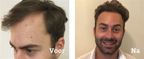 Wat Te Verwachten Tijdens Een Haartransplantatie?