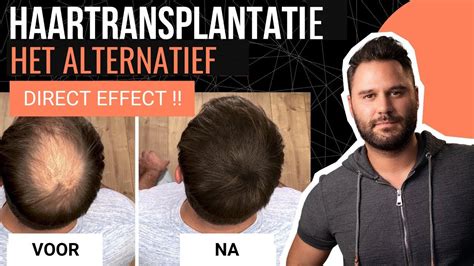 Haartransplantatie En Voeding: Wat Dit Voor Je Haar Betekent