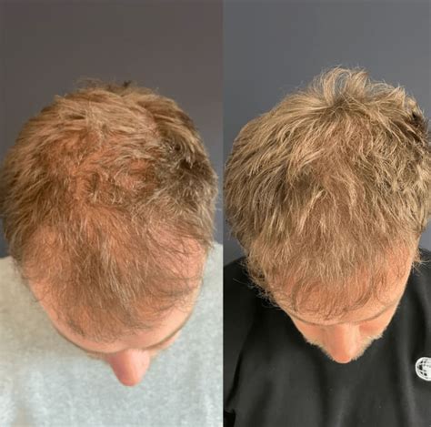 Haartransplantatie Voor Vrouwen: Wat Jij Moet Weten