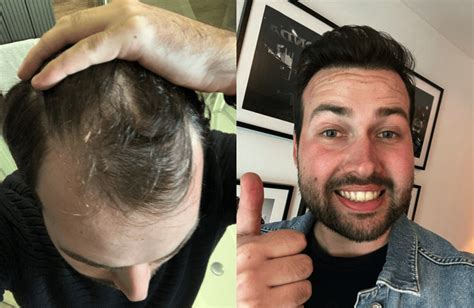 Haartransplantatie: Hoe Verandert Het Je Leven?