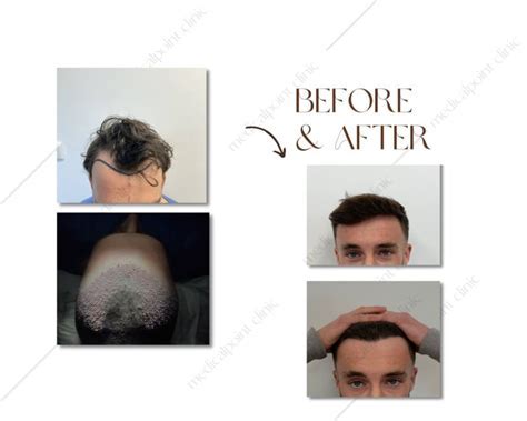 Haartransplantatie In De Toekomst: Wat Te Verwachten?