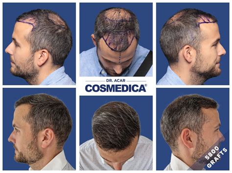 Haartransplantatie Resultaten: Wat Is Normaal?